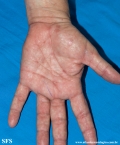 syphilis secondary
