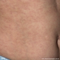 syphilis secondary