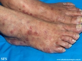 syphilis secondary