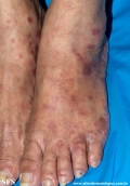 syphilis secondary