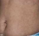 syphilis secondary