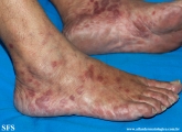 syphilis secondary