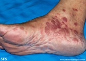 syphilis secondary