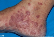 syphilis secondary
