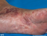 syphilis secondary