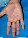 syphilis secondary