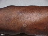 syphilis secondary