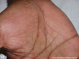 syphilis secondary