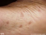 syphilis secondary