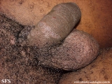 syphilis secondary