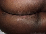 syphilis secondary