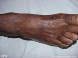 syphilis secondary
