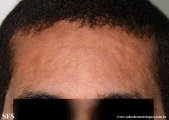 syphilis secondary