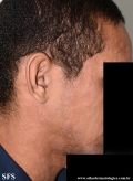 syphilis secondary