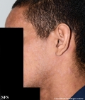 syphilis secondary