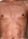 syphilis secondary