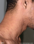 syphilis secondary