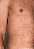 syphilis secondary