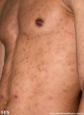 syphilis secondary