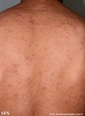 syphilis secondary