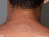 syphilis secondary
