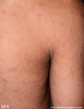 syphilis secondary