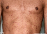 syphilis secondary