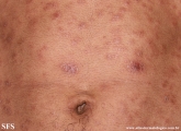 syphilis secondary