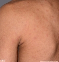 syphilis secondary