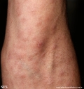 syphilis secondary