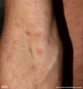 syphilis secondary