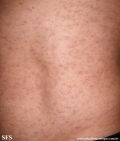 syphilis secondary