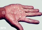 syphilis secondary