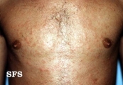 syphilis secondary