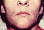 syphilis secondary