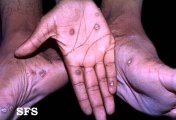 syphilis secondary