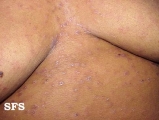 syphilis secondary