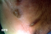 syphilis secondary