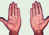syphilis secondary