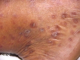 syphilis secondary