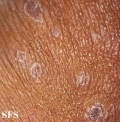syphilis secondary