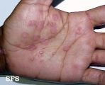 syphilis secondary