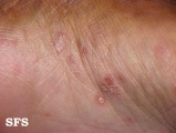 syphilis secondary