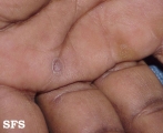 syphilis secondary