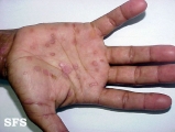 syphilis secondary