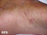 syphilis secondary