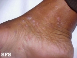 syphilis secondary