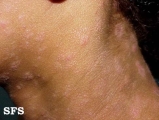 syphilis secondary