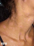 syphilis secondary
