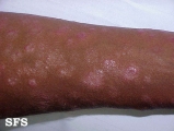 syphilis secondary